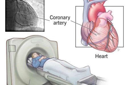 CT Angiogram