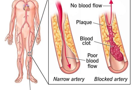 Peripheral Artery Disease