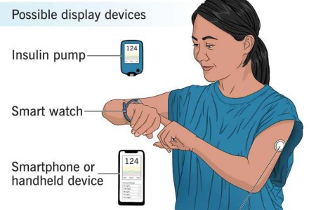 Continuous Glucose Monitoring (CGM)