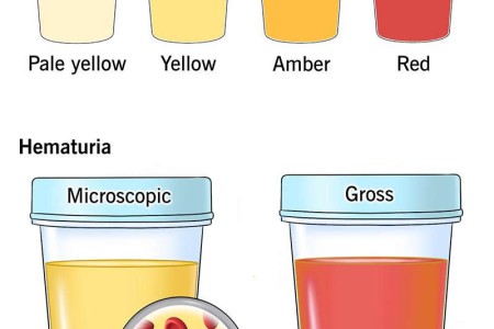 Hematuria