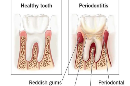 Periodontitis