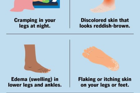 Chronic Venous Insufficiency (CVI)