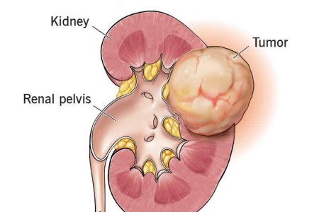 Kidney Cancer