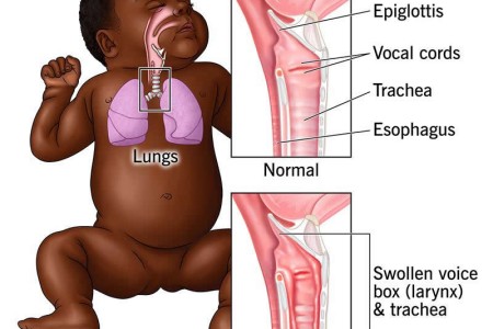 Croup
