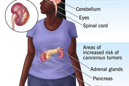 von Hippel-Lindau Disease (VHL)