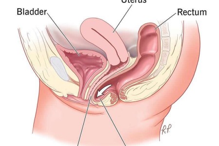 Rectocele