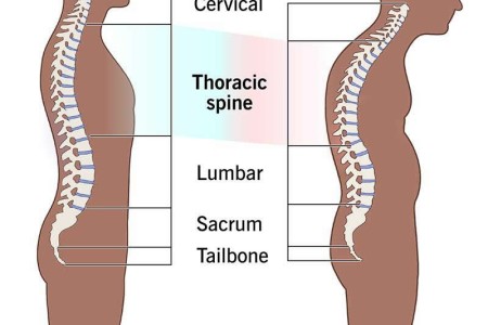 Kyphosis