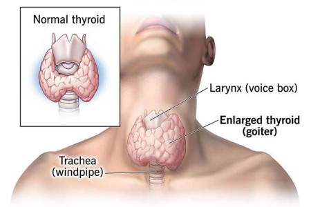 Hashimoto’s Disease