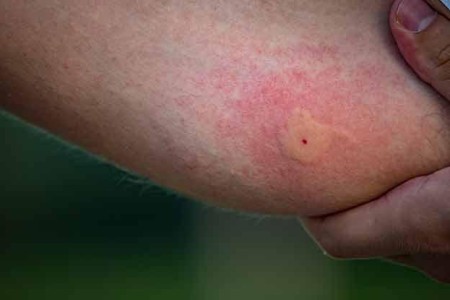 Mosquito Bites