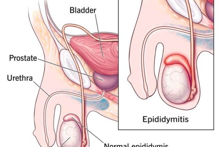 Epididymitis