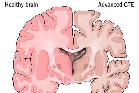 Chronic Traumatic Encephalopathy (CTE)