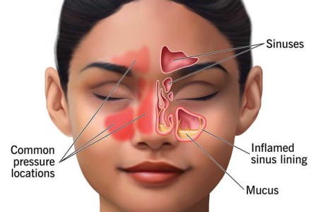 Sinus Infection (Sinusitis)