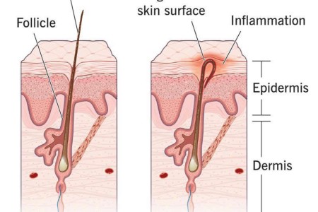 Ingrown Hair