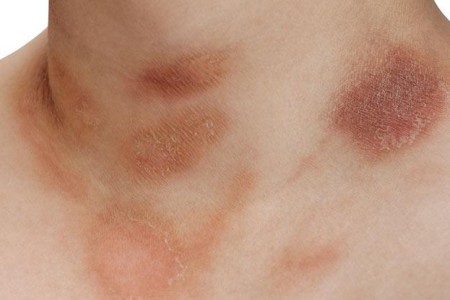 Pityriasis Rosea