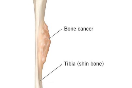 Bone Cancer