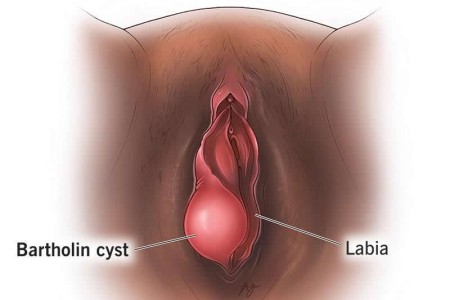 Bartholin Cyst