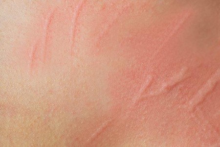 Dermatographia
