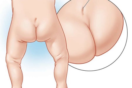 Sacral Dimple