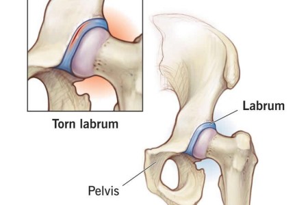 Hip Labral Tear