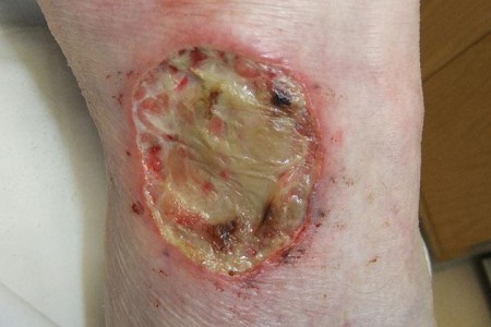 Pyoderma Gangrenosum