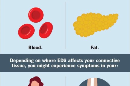 Ehlers-Danlos Syndrome