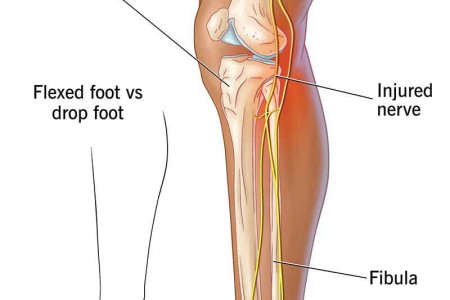 Foot Drop