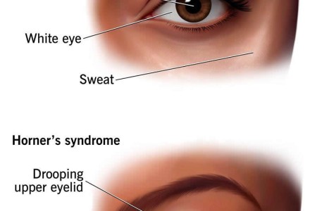 Horner Syndrome
