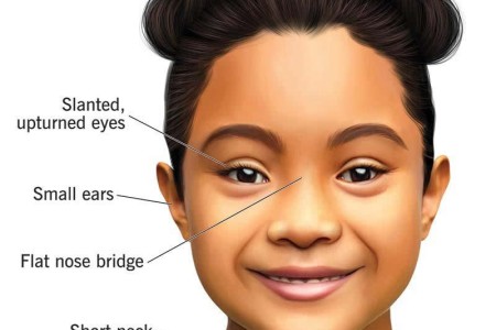 Down Syndrome