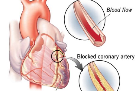 Myocardial Ischemia
