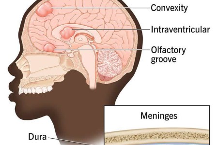 Meningioma