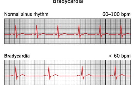 Bradycardia