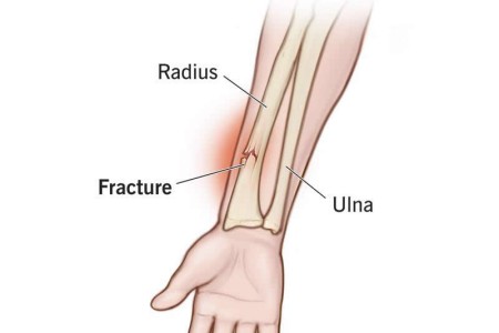 Greenstick Fractures