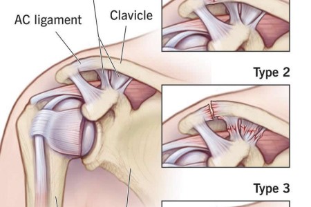 Separated Shoulder