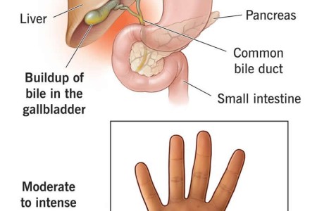 Cholestasis of Pregnancy