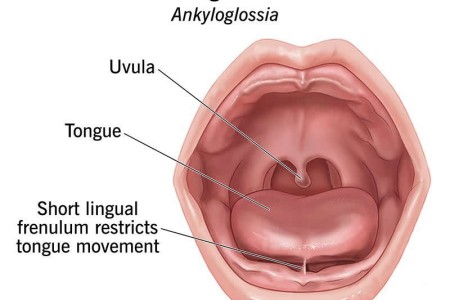 Tongue-Tie (Ankyloglossia)