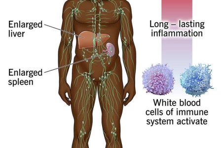 Castleman Disease
