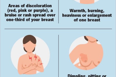Inflammatory Breast Cancer