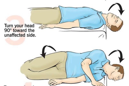 Canalith Repositioning Procedure