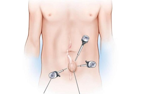 Hernia Repair Surgery