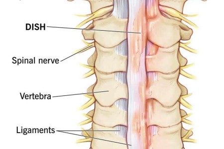 Diffuse Idiopathic Skeletal Hyperostosis (DISH)