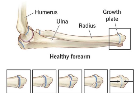 Salter-Harris Fracture (Growth Plate Fracture)