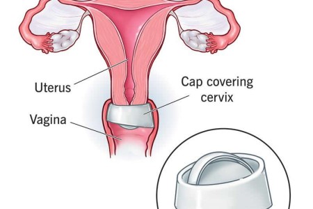 Cervical Cap