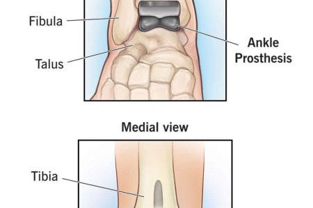 Ankle Surgery