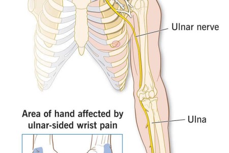 Ulnar Wrist Pain