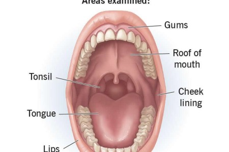 Oral Cancer Screening