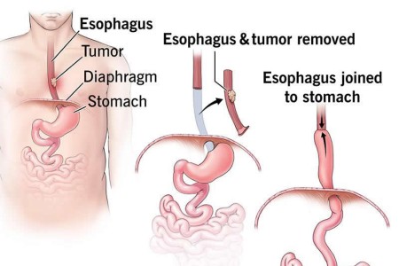Esophagectomy