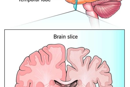 Frontotemporal Dementia