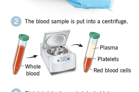 Platelet-Rich Plasma (PRP Injection)