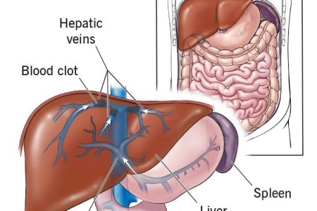 Budd-Chiari Syndrome