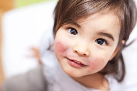 When Your Child’s ‘Chapped Cheeks’ May Actually Be a Common Childhood Infection